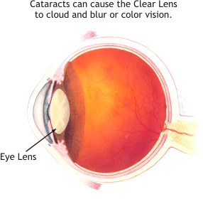 Cataracts cause clouding of the lens inside your eye and vision distortion.